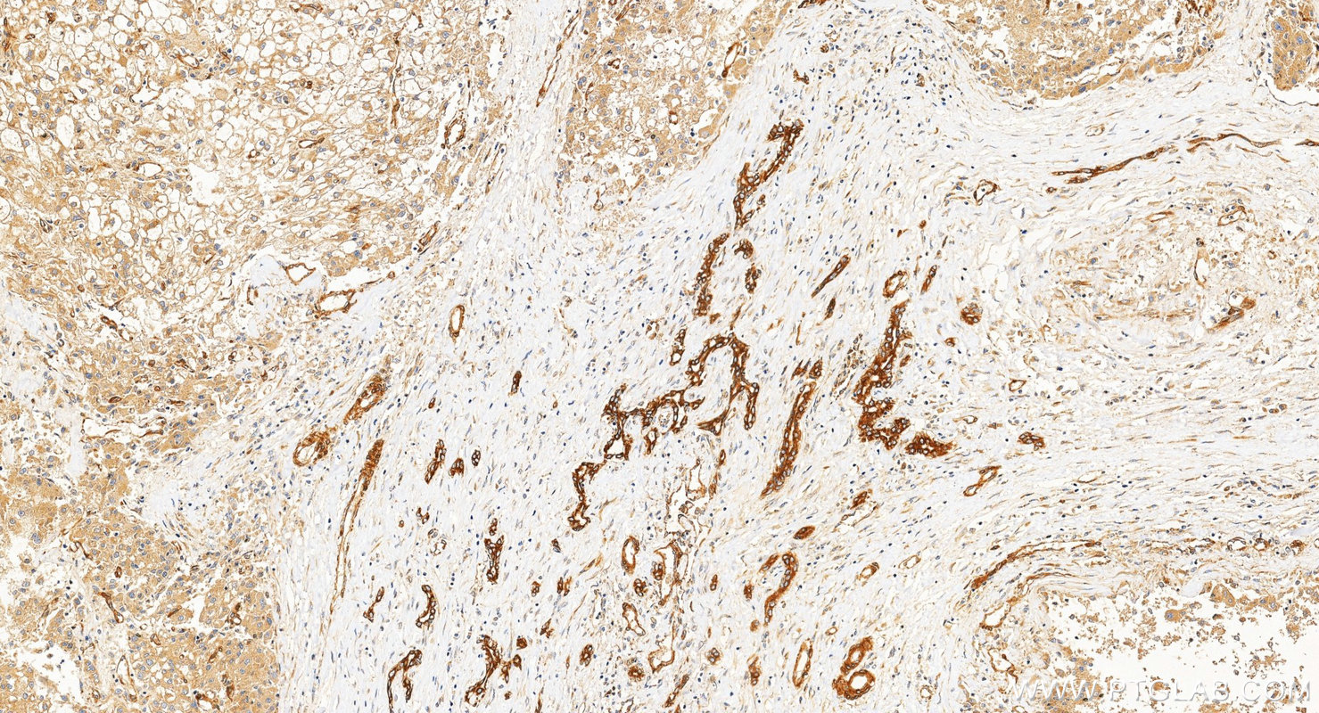 IHC staining of Hepatocellular carcinoma using 12636-1-AP IHC staining of Hepatocellular carcinoma using 12636-1-AP
