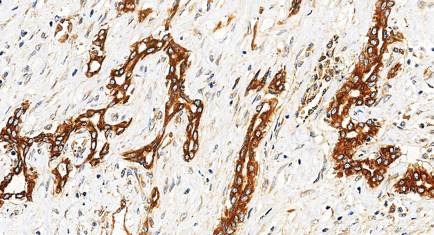 IHC staining of Hepatocellular carcinoma using 12636-1-AP IHC staining of Hepatocellular carcinoma using 12636-1-AP