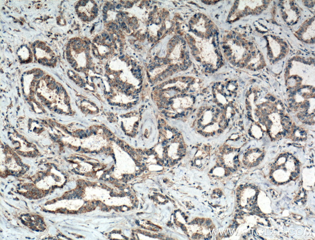 IHC staining of human breast cancer using 66258-1-Ig