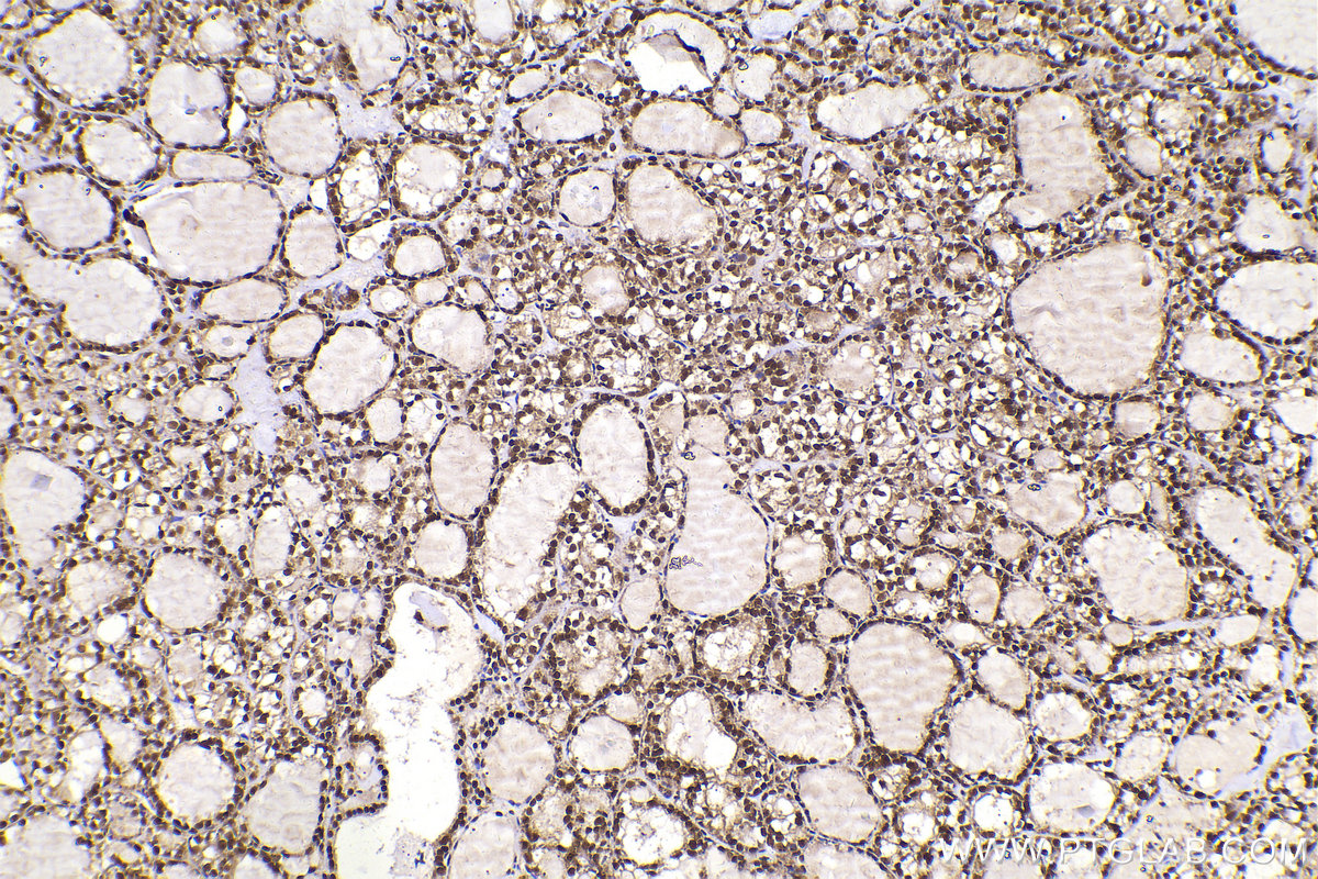 IHC staining of human thyroid cancer using 12176-1-AP