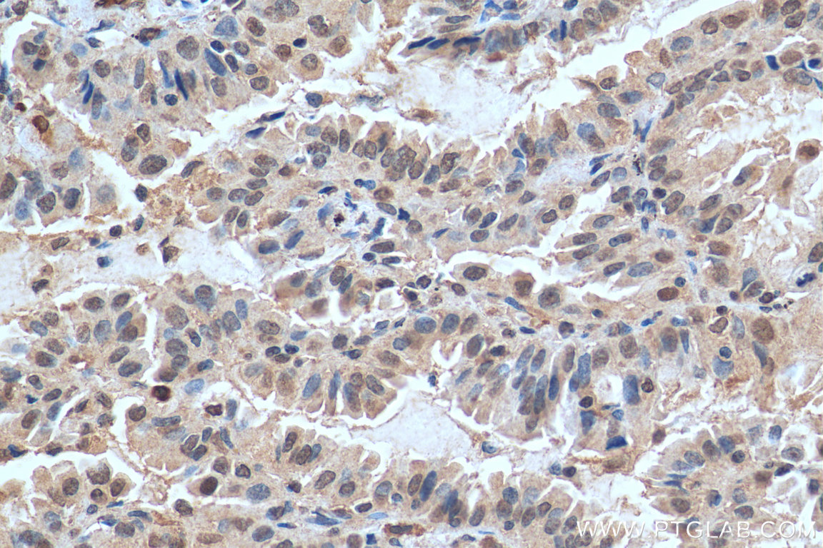 IHC staining of human lung cancer using 29407-1-AP