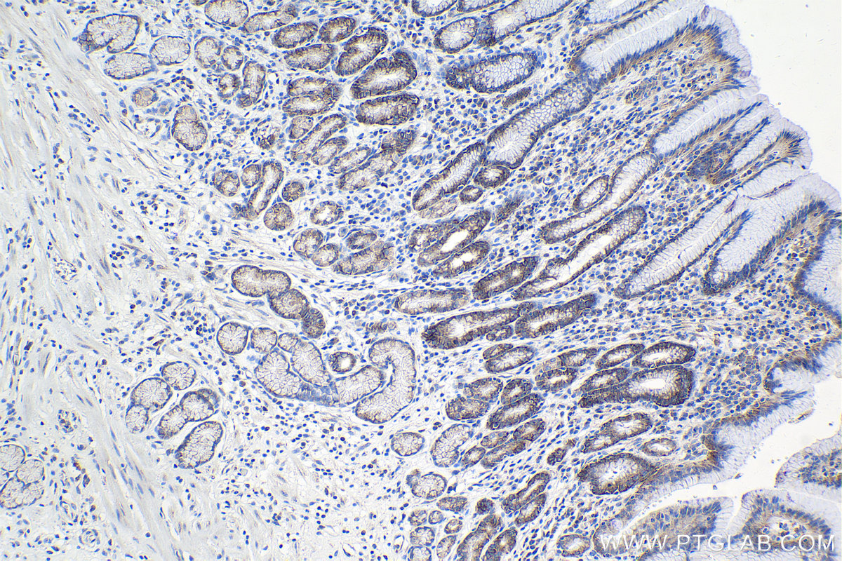 Immunohistochemical analysis of paraffin-embedded human stomach cancer tissue slide using 21529-1-AP (FAM120A antibody) at dilution of 1:500 (under 10x lens). Heat mediated antigen retrieval with Tris-EDTA buffer (pH 9.0). IHC staining of human stomach cancer using 21529-1-AP