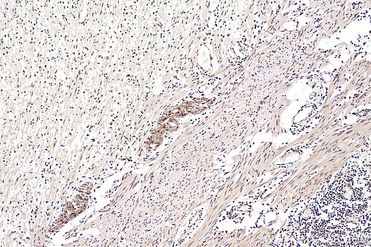 IHC staining of human colon cancer using 21313-1-AP