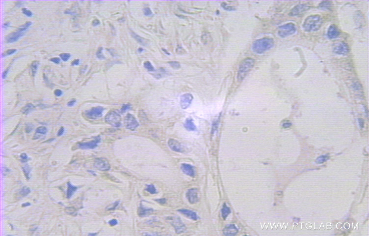 Immunohistochemical analysis of paraffin-embedded human pancreas cancer using 10307-1-AP (FAM127A antibody) at dilution of 1:100 (under 25x lens). IHC staining of human pancreas cancer using 10307-1-AP