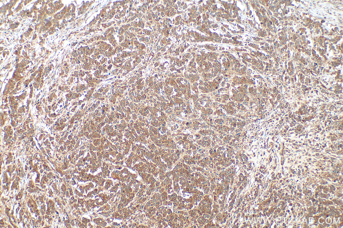 Immunohistochemical analysis of paraffin-embedded human colon cancer tissue slide using 20282-1-AP (FAM127 antibody) at dilution of 1:400 (under 10x lens). Heat mediated antigen retrieval with Tris-EDTA buffer (pH 9.0). IHC staining of human colon cancer using 20282-1-AP