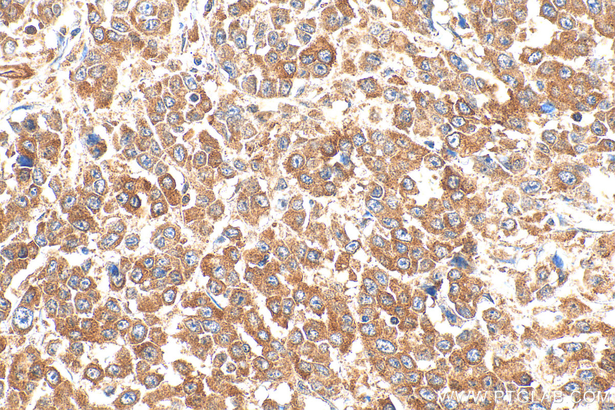 Immunohistochemical analysis of paraffin-embedded human colon cancer tissue slide using 20282-1-AP (FAM127 antibody) at dilution of 1:400 (under 40x lens). Heat mediated antigen retrieval with Tris-EDTA buffer (pH 9.0). IHC staining of human colon cancer using 20282-1-AP