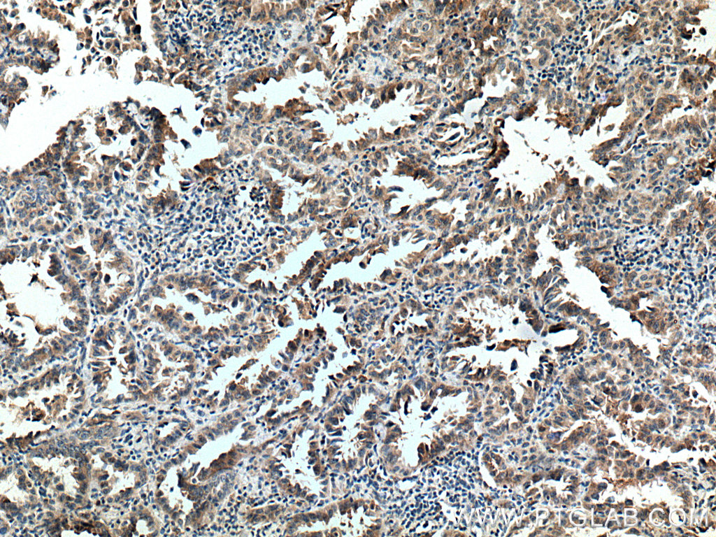 IHC staining of human lung cancer using 16914-1-AP