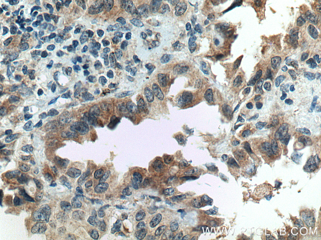 IHC staining of human lung cancer using 16914-1-AP