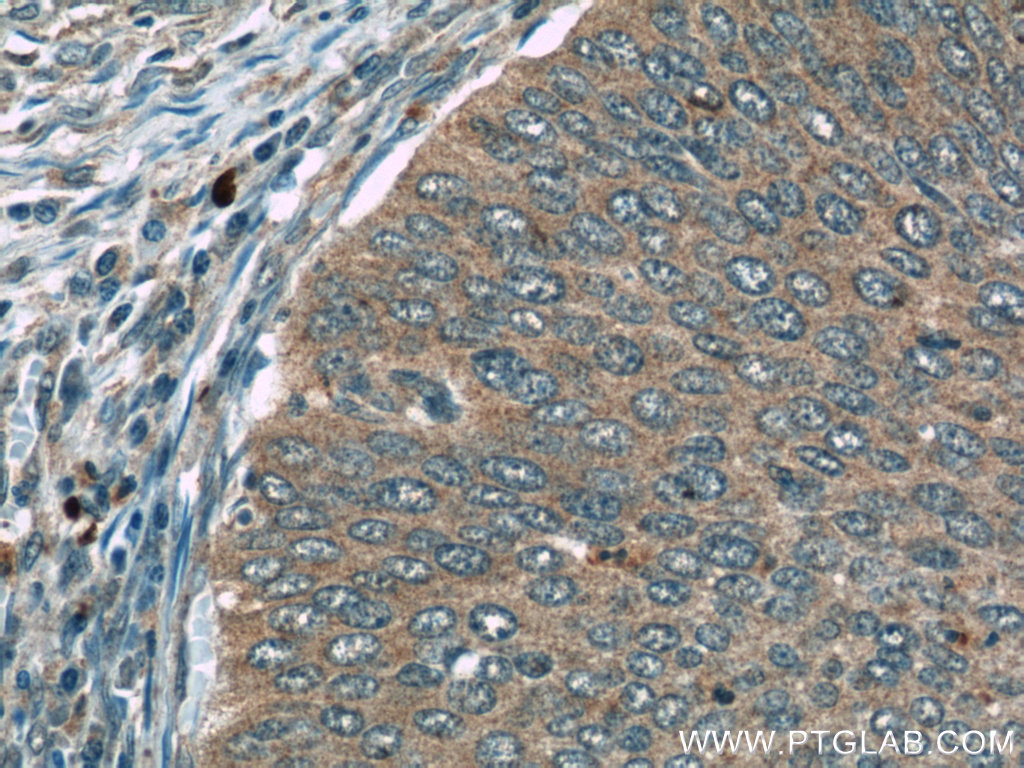 IHC staining of human cervical cancer using 24422-1-AP