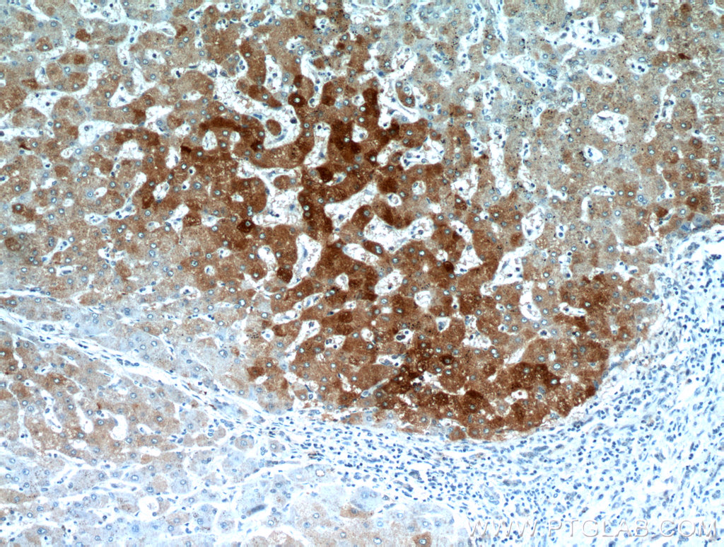 IHC staining of human hepatocirrhosis using 20911-1-AP