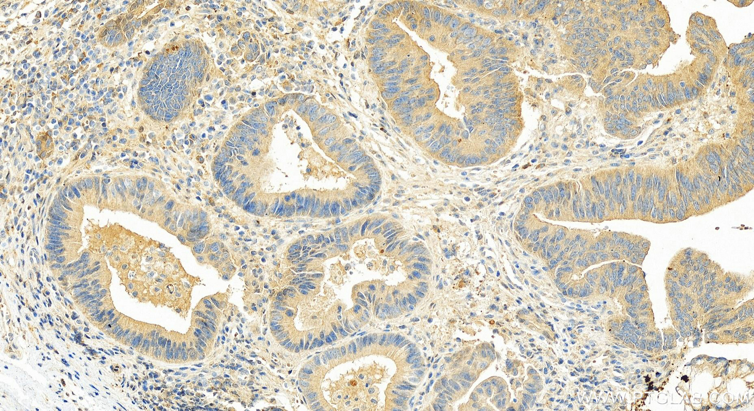 IHC staining of human colon cancer using 25258-1-AP