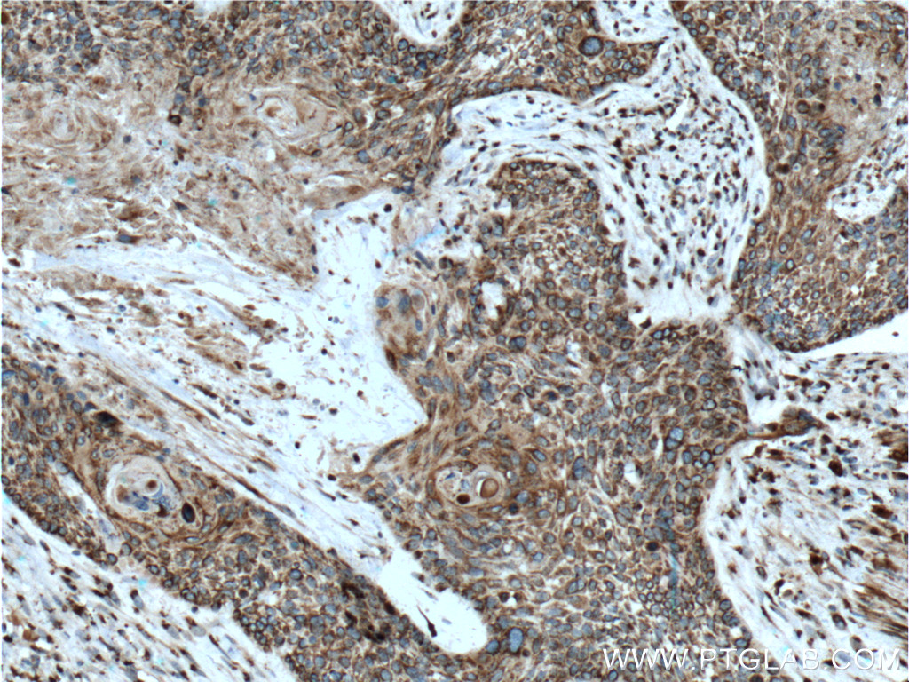 IHC staining of human oesophagus cancer using 60282-1-Ig