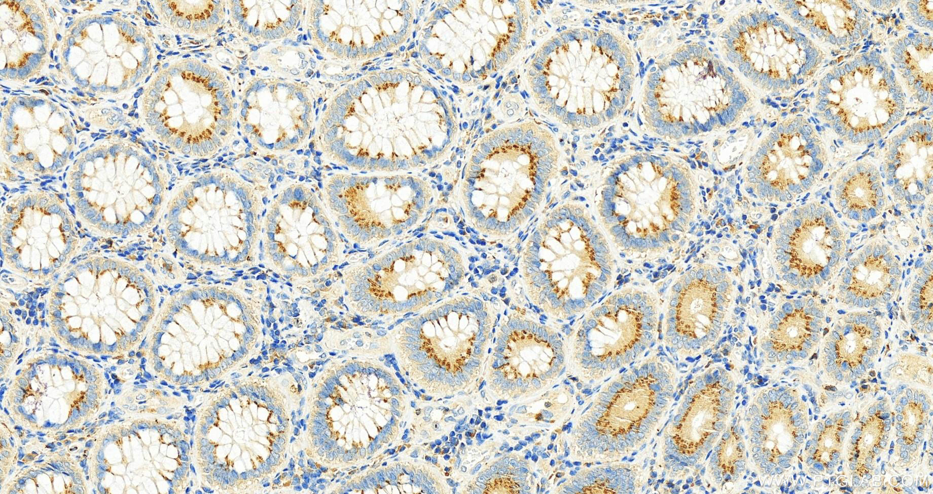 IHC staining of human colon cancer using 20996-1-AP (same clone as 20996-1-PBS)