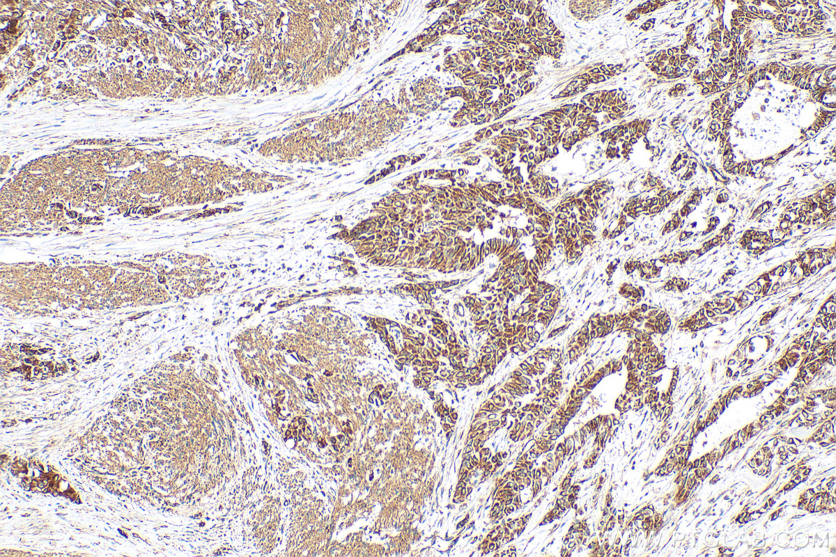 IHC staining of human urothelial carcinoma using 33752-1-AP