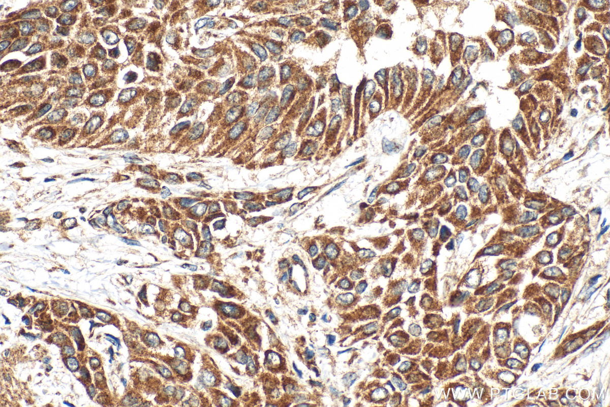 IHC staining of human urothelial carcinoma using 33752-1-AP