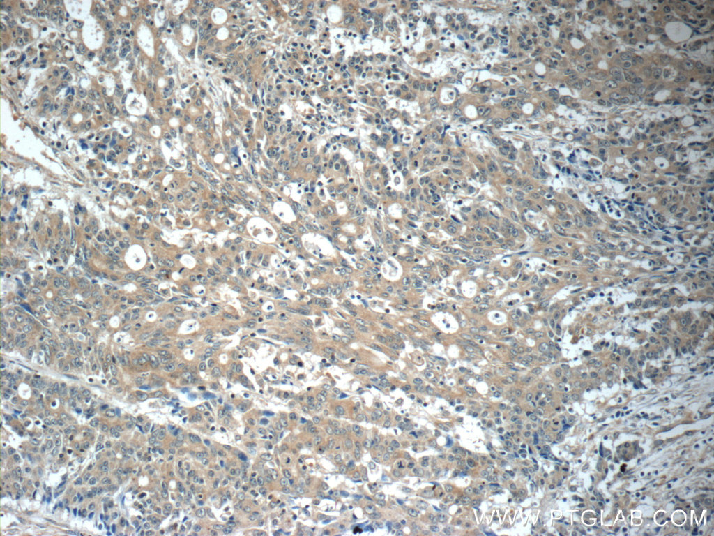 IHC staining of human colon cancer using 20618-1-AP