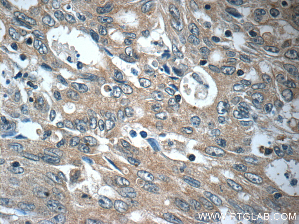 IHC staining of human colon cancer using 20618-1-AP
