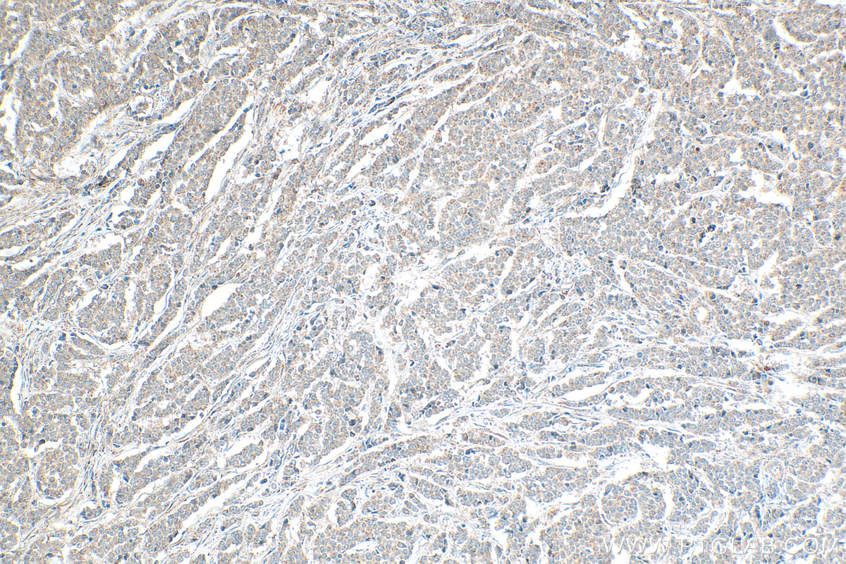 IHC staining of human colon cancer using 29289-1-AP