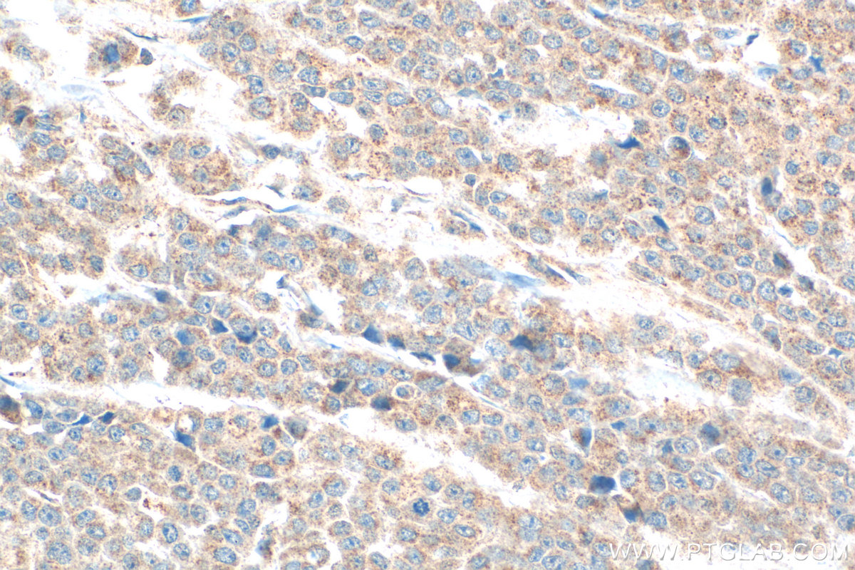 IHC staining of human colon cancer using 29289-1-AP