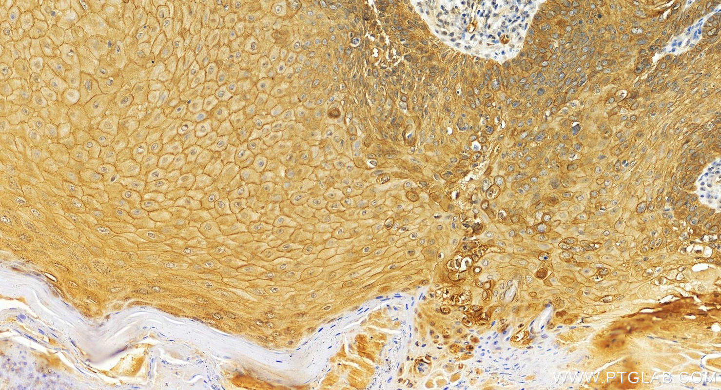 IHC staining of human brown disease using 26032-1-AP