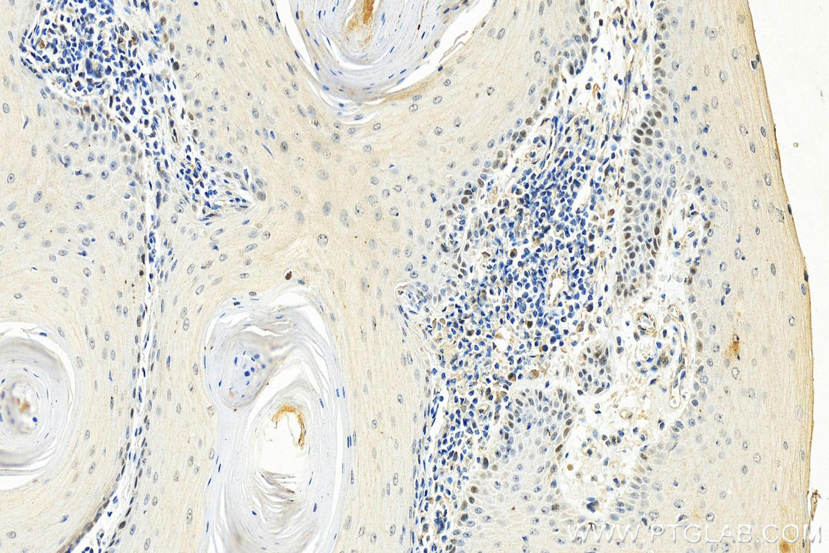 IHC staining of human skin cancer using 67304-1-Ig