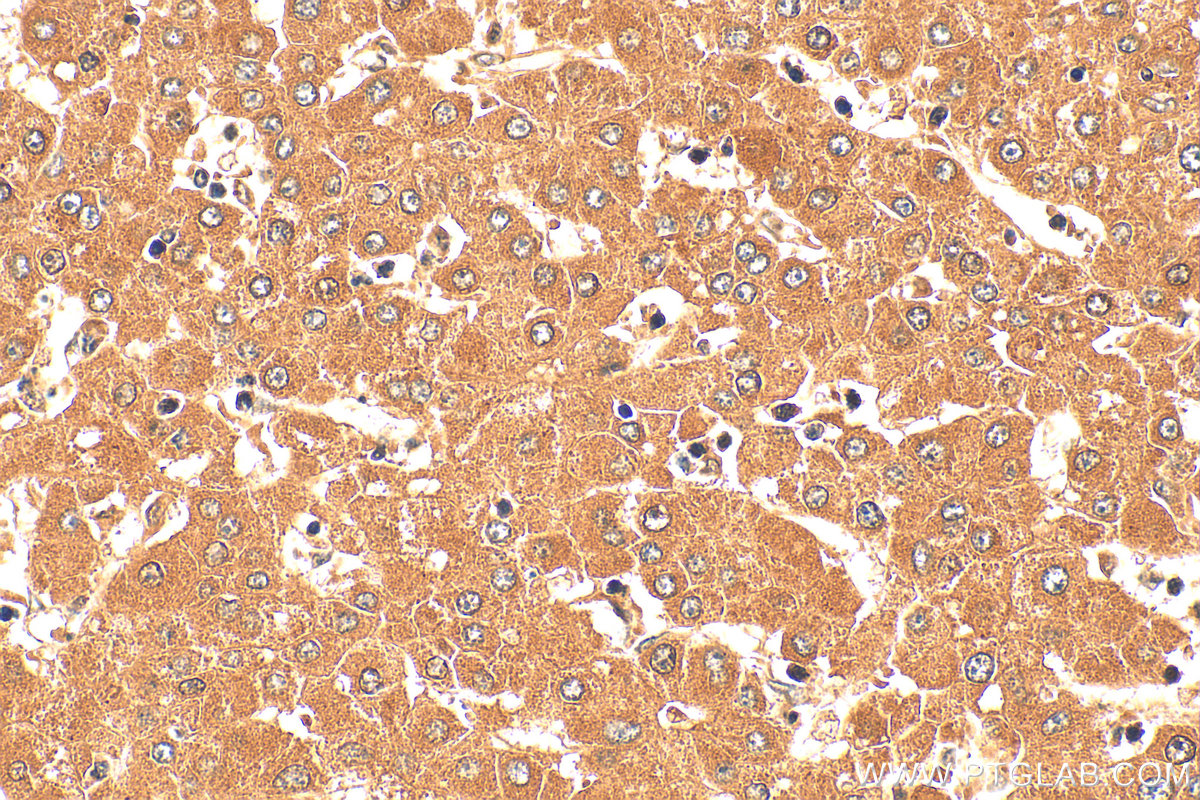IHC staining of human liver cancer using 16436-1-AP