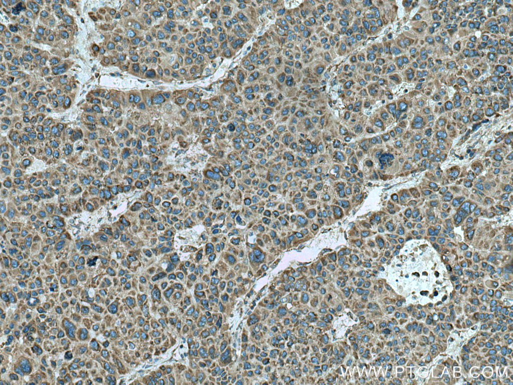 IHC staining of human liver cancer using 18121-1-AP (same clone as 18121-1-PBS)
