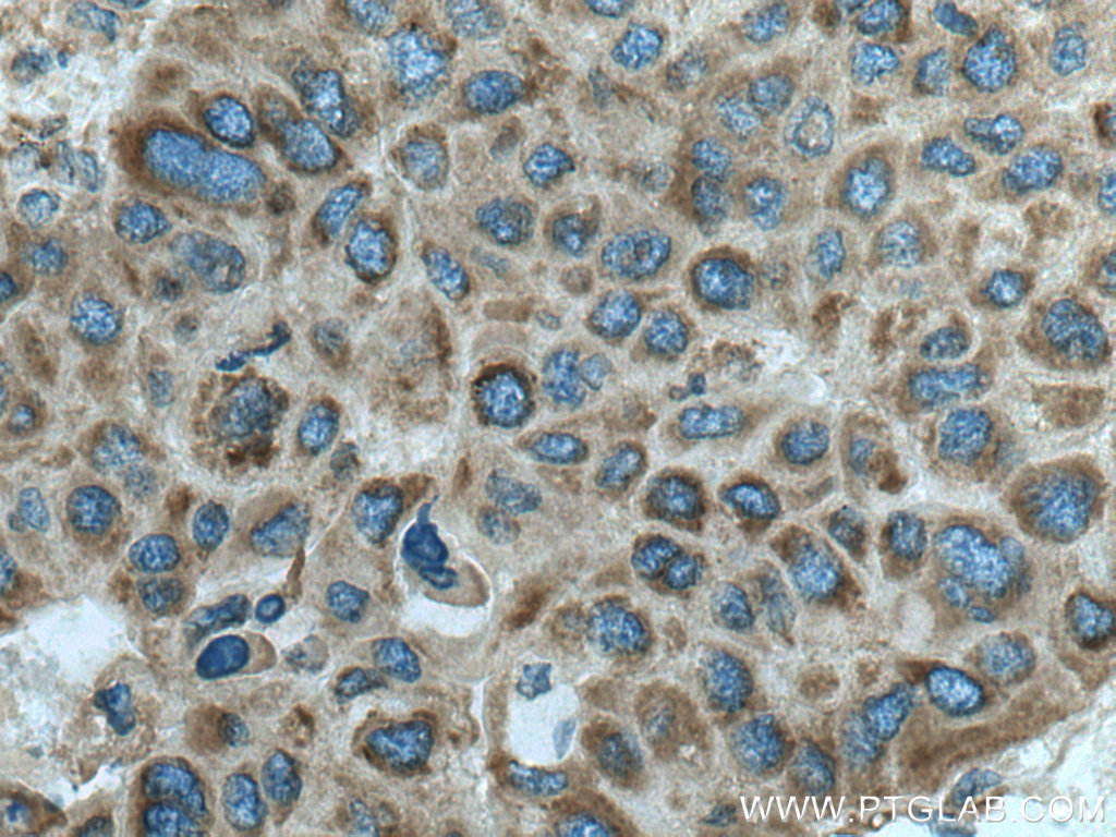 IHC staining of human liver cancer using 18121-1-AP (same clone as 18121-1-PBS)