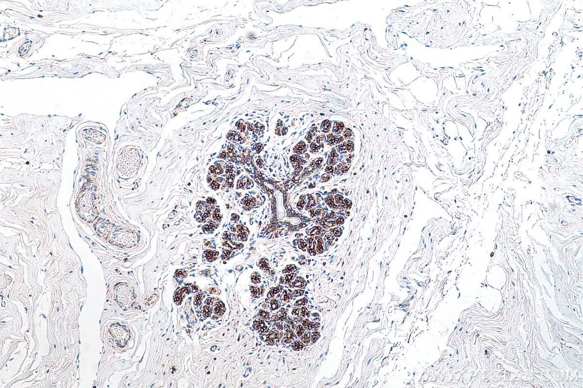 IHC staining of human breast cancer using 67945-1-Ig (same clone as 67945-1-PBS)