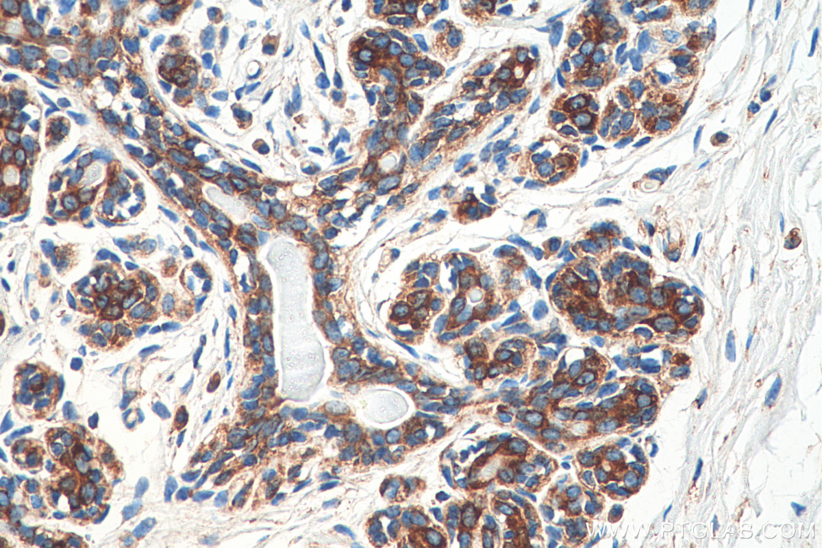 IHC staining of human breast cancer using 67945-1-Ig (same clone as 67945-1-PBS)
