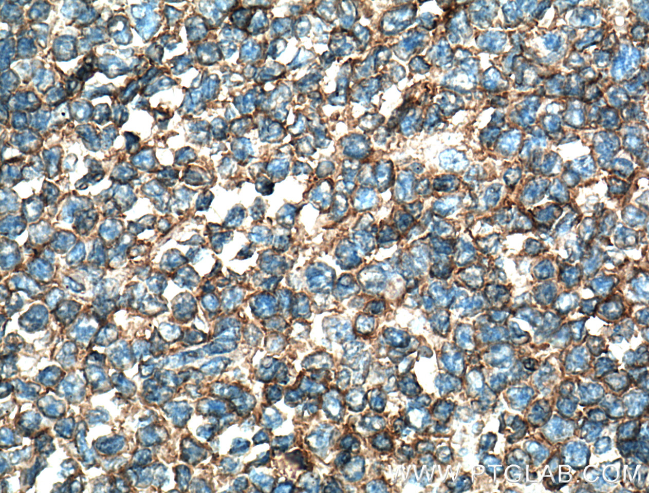 IHC staining of human tonsillitis using 60196-1-Ig (same clone as 60196-1-PBS)