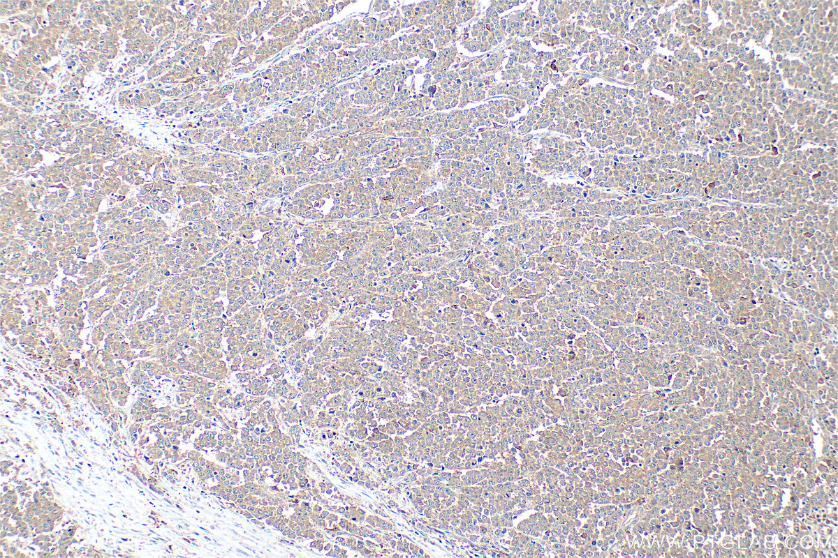 IHC staining of human colon cancer using 33468-1-AP IHC staining of human colon cancer using 33468-1-AP
