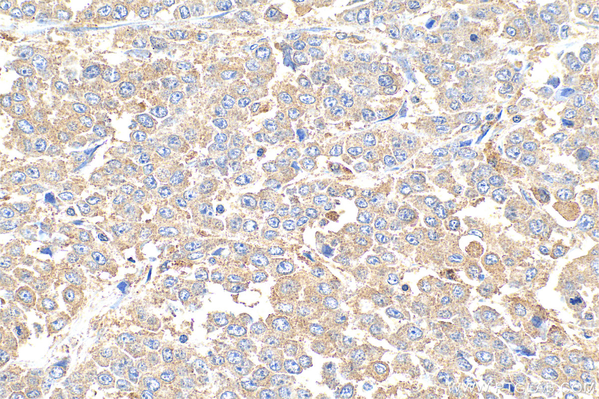 IHC staining of human colon cancer using 33468-1-AP IHC staining of human colon cancer using 33468-1-AP