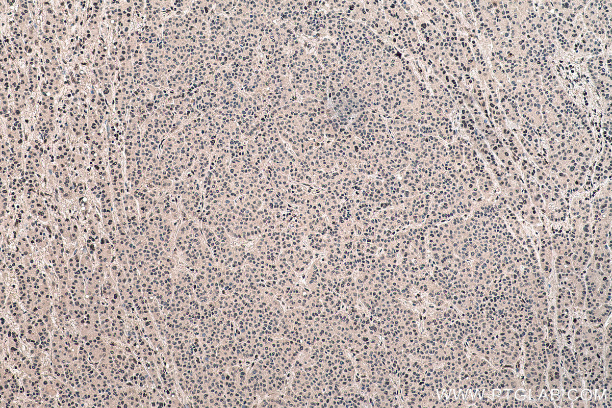 IHC staining of human liver cancer using 66985-1-Ig (same clone as 66985-1-PBS)