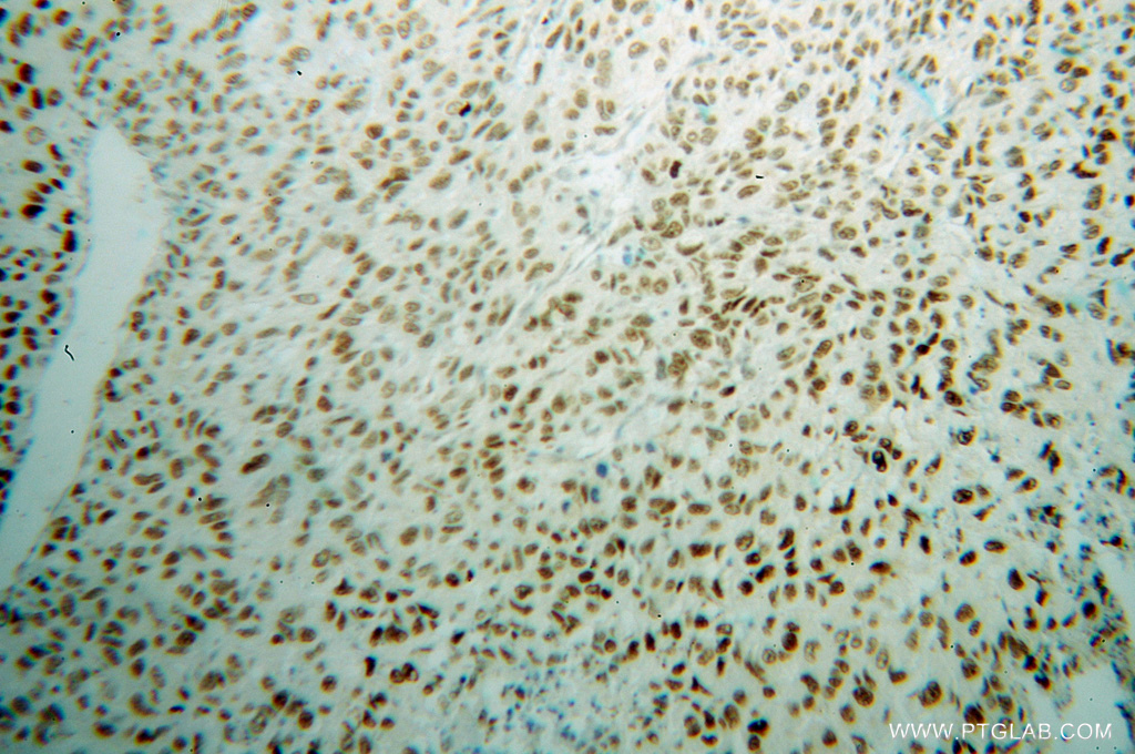 IHC staining of human lung cancer using 13349-1-AP