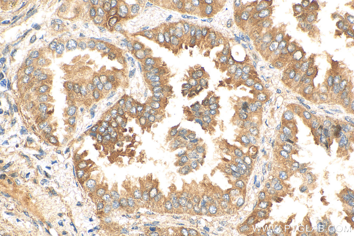 IHC staining of human lung cancer using 29992-1-AP
