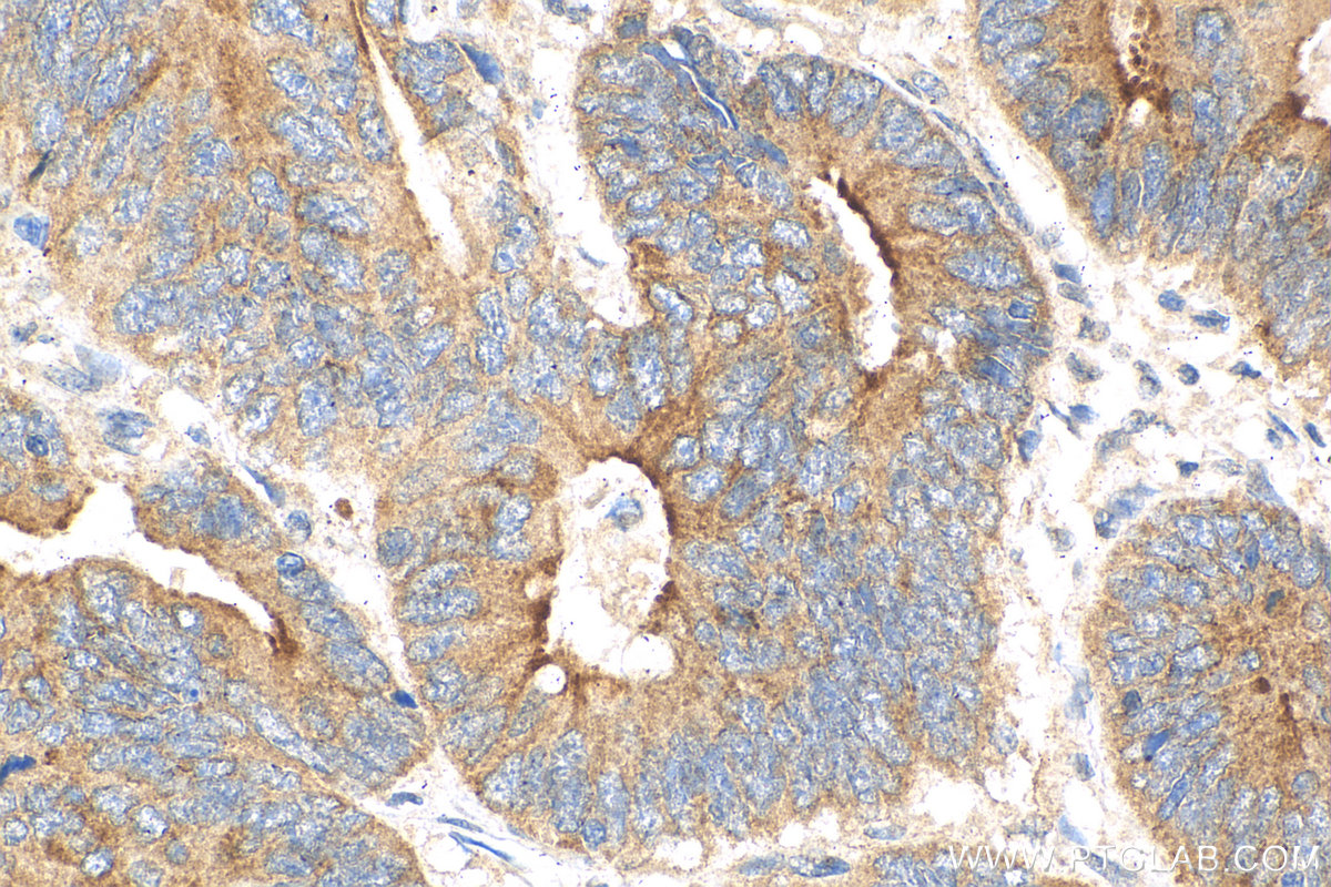 IHC staining of human colon cancer using 29992-1-AP (same clone as 29992-1-PBS)