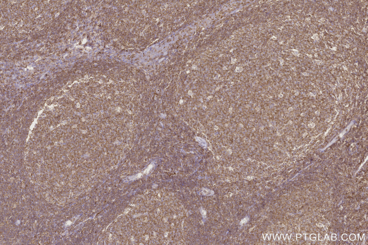 IHC staining of human tonsillitis using 27056-1-AP IHC staining of human tonsillitis using 27056-1-AP