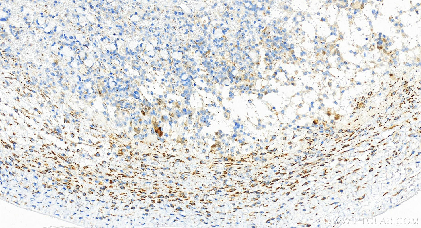 IHC staining of human ovary cancer using 83910-5-RR