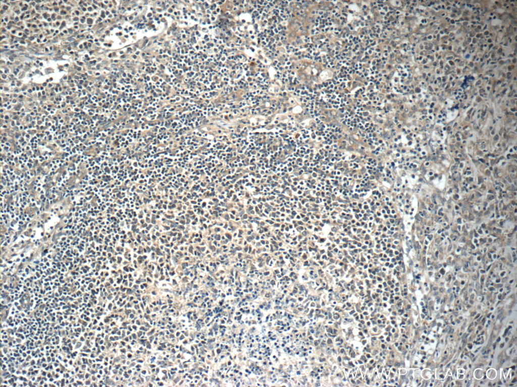 IHC staining of human lymphoma using 11556-1-AP