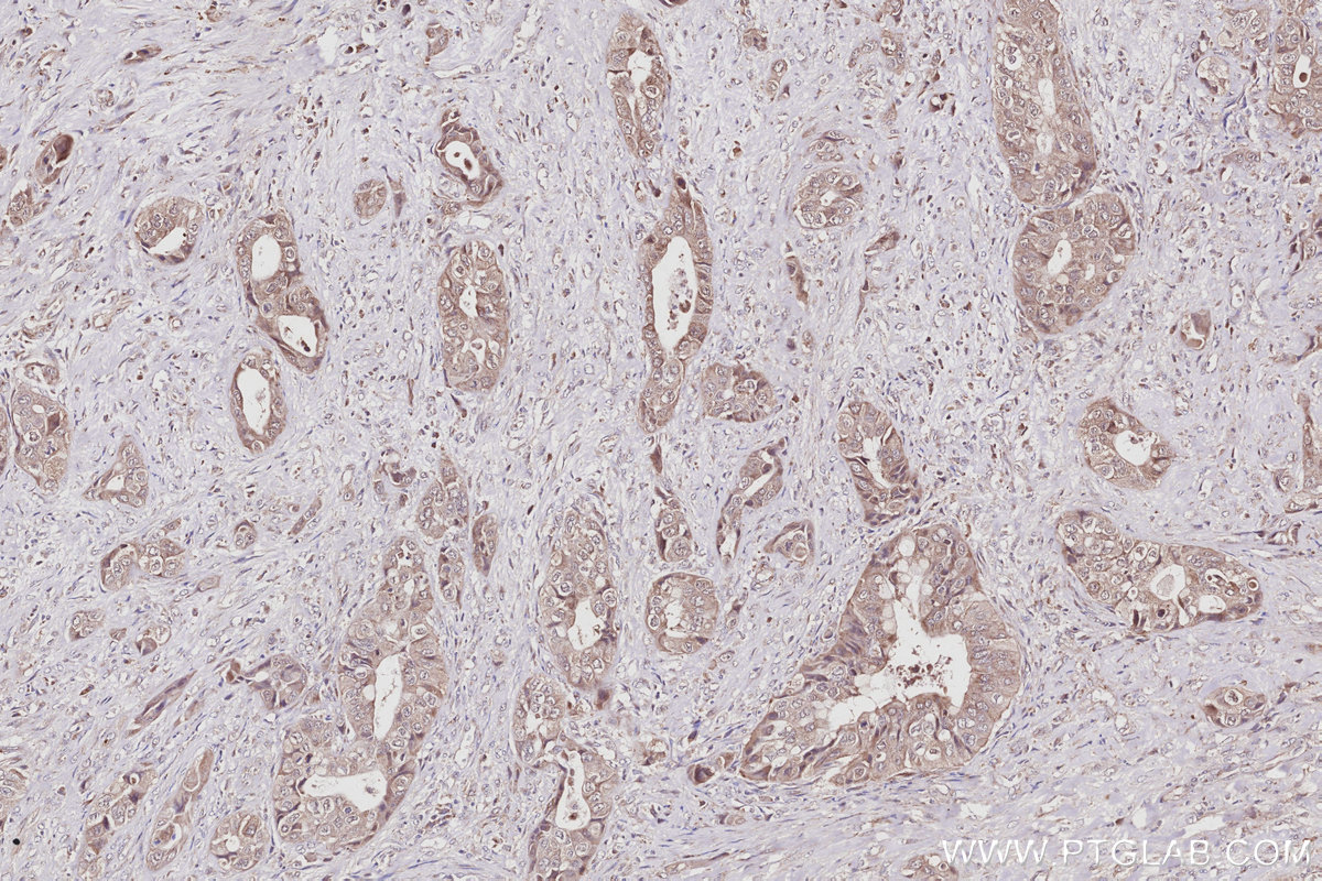 IHC staining of human pancreas cancer using 13855-1-AP IHC staining of human pancreas cancer using 13855-1-AP