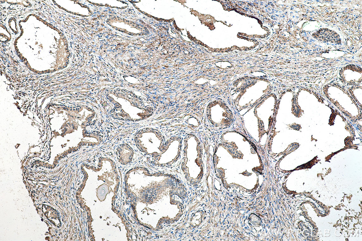 IHC staining of human prostate cancer using 11830-1-AP