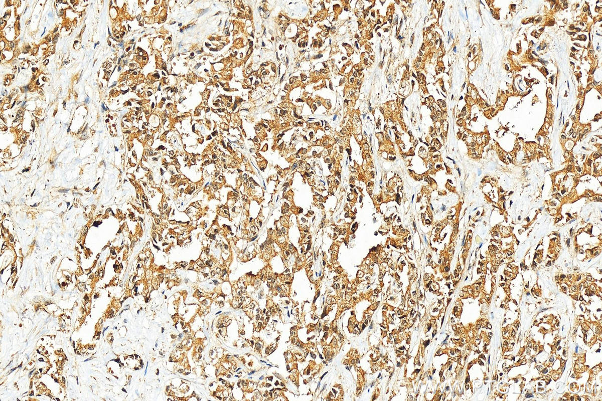 IHC staining of human intrahepatic cholangiocarcinoma using 10696-1-AP