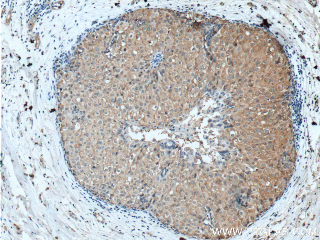 IHC staining of human breast cancer using 21687-1-AP