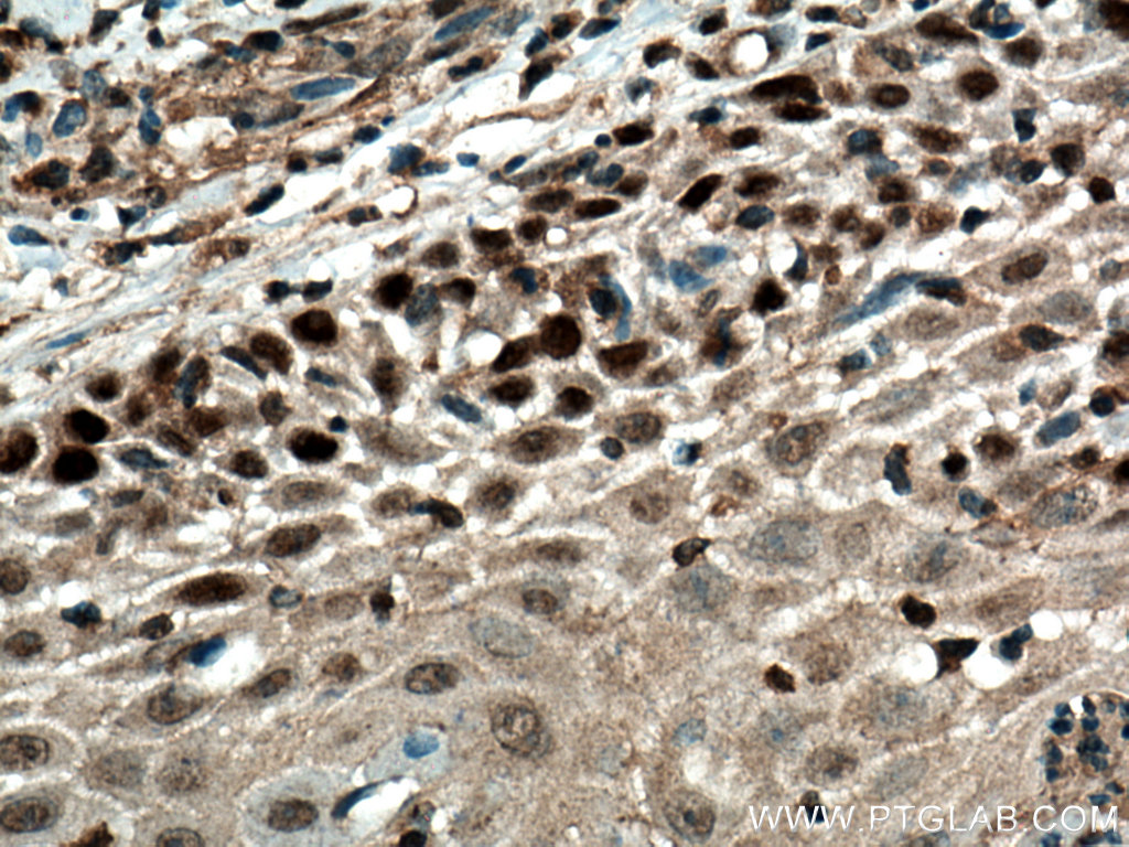 IHC staining of human skin cancer using 55290-1-AP