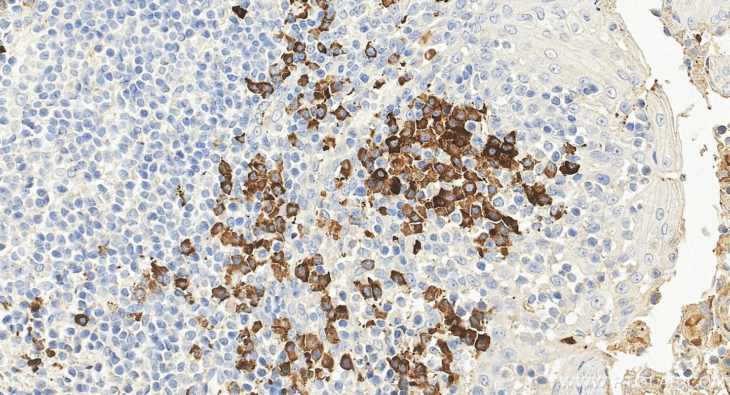 IHC staining of human tonsillitis using 68275-1-Ig