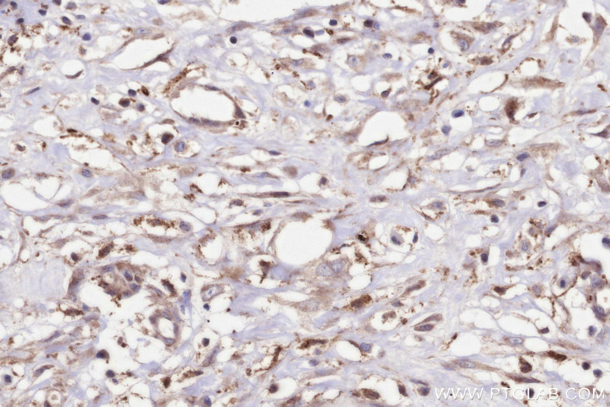 IHC staining of human colon cancer using 16190-1-AP