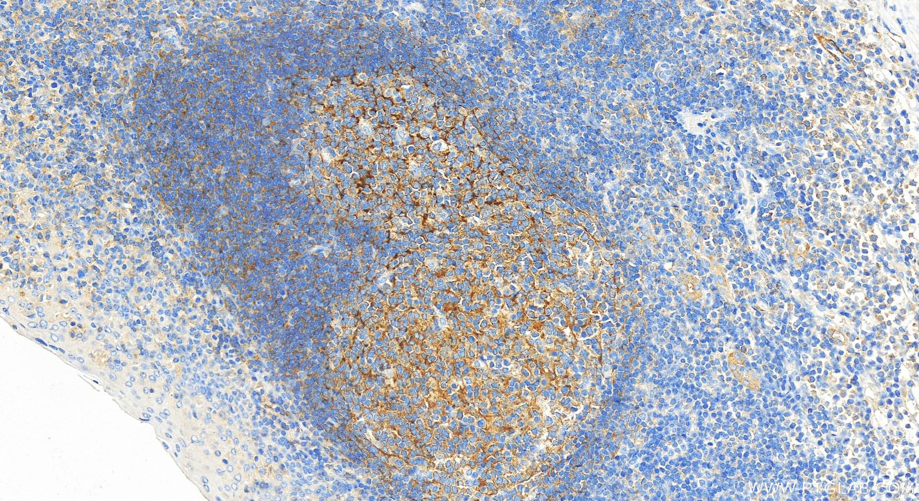 Immunohistochemical analysis of paraffin-embedded human tonsillitis tissue slide using 26767-1-AP (FCHO1 antibody) at dilution of 1:1600 (under 20x lens). Heat mediated antigen retrieval with Tris-EDTA buffer (pH 9.0). IHC staining of human tonsillitis using 26767-1-AP