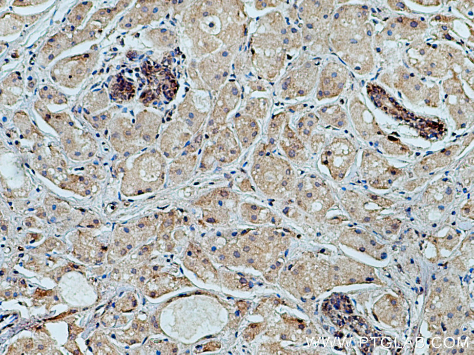 IHC staining of human breast cancer using 23362-1-AP