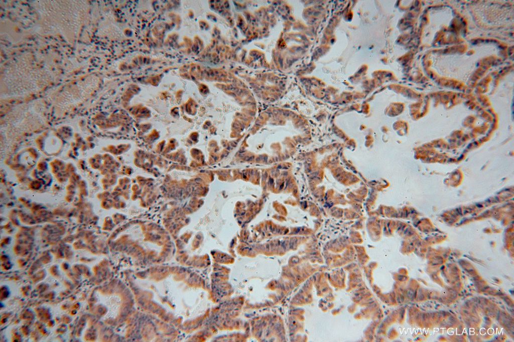 IHC staining of human lung cancer using 17157-1-AP
